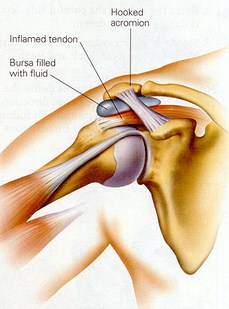 Los Angeles, West Hollywood, Beverly Hills Chiropractor Dr. Nick Campos Shoulder Impingement
