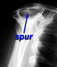 bone spur of the shoulder