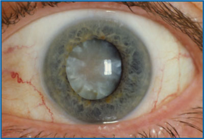 cataracts, vitamin C- Los Angeles chiropractic office