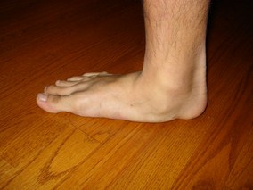 Beverly Hills chiropractic flat feet