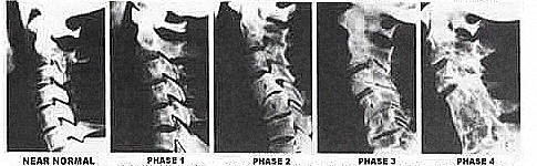 West Hollywood Subluxation Chiropractor