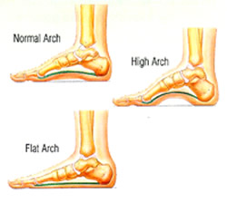 Beverly Hills Chiropractor--flat feet