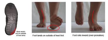 West Hollywood Chiropractor--overpronation