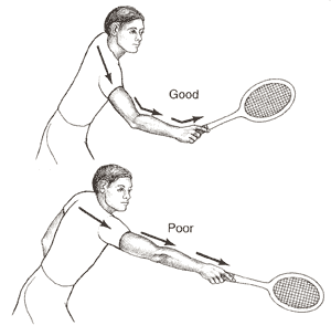Prevention, Tennis elbow- Sports chiropractor Beverly Hills